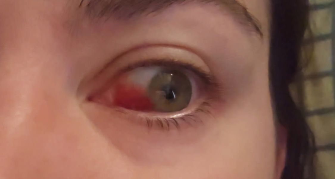 Bloodshot eye w/picture