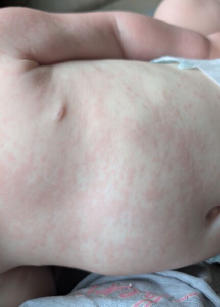 Fever no other clear symptoms