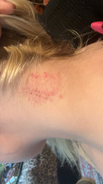 Does this look like skin cancer? Pic attached