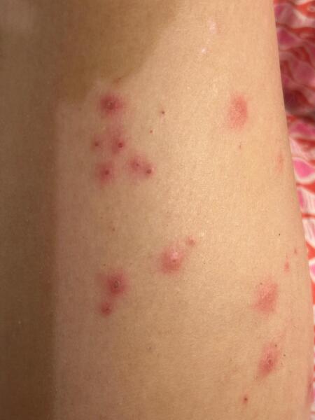Any guesses for this rash? DD 11