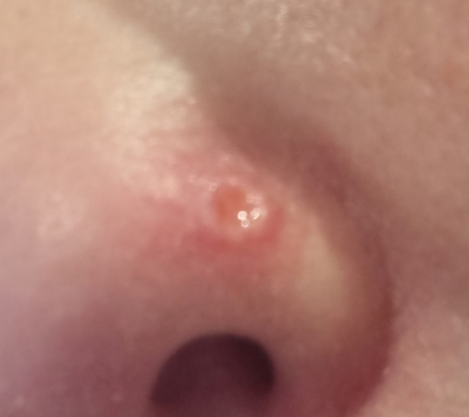 Persistent spot on my nose that has not healed for a year