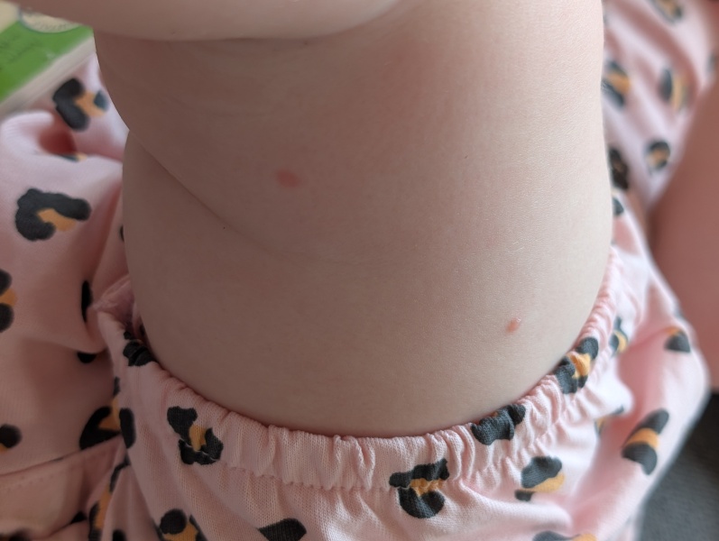 Chicken pox or something else??