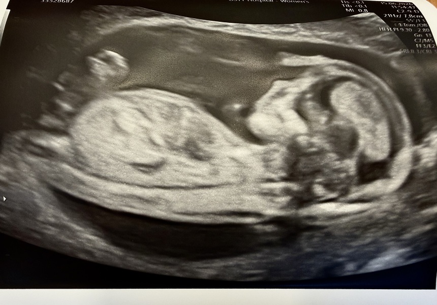 Any guesses on nub theory from my 13 week scan