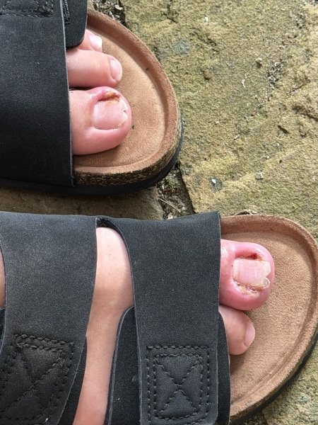 Partial toenail avulsion with phenol