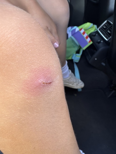 TW photo of possibly infected scratch