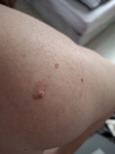 Not sure what mole?