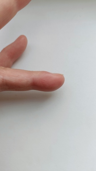 Pathetically small amount of pus generated by self-inflicted infected finger.