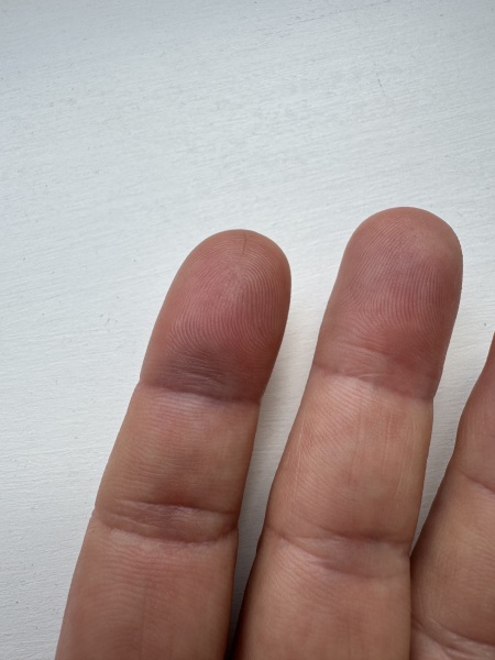 Sudden swollen finger joint - what could be causing it?