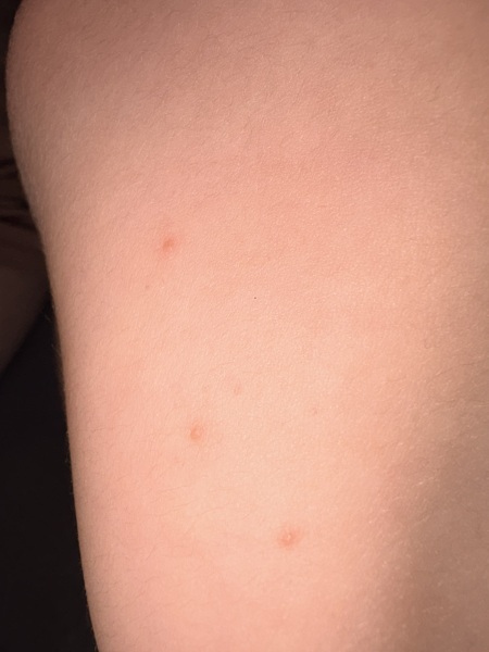 Could this be a second, milder case of chickenpox in my son?