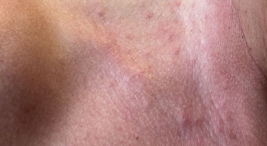 What kind of rash would you say ?