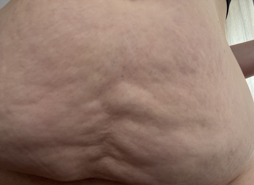 Postnatal lower stomach appearance after two sections and nearly at pre-baby weight HELP