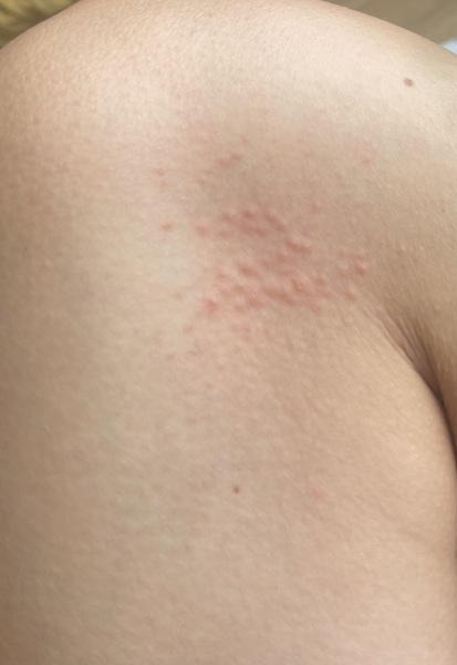 AIBU to not worry about a sudden rash on my knee