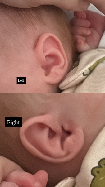 Noticed my seven-week-old baby’s ears look very different