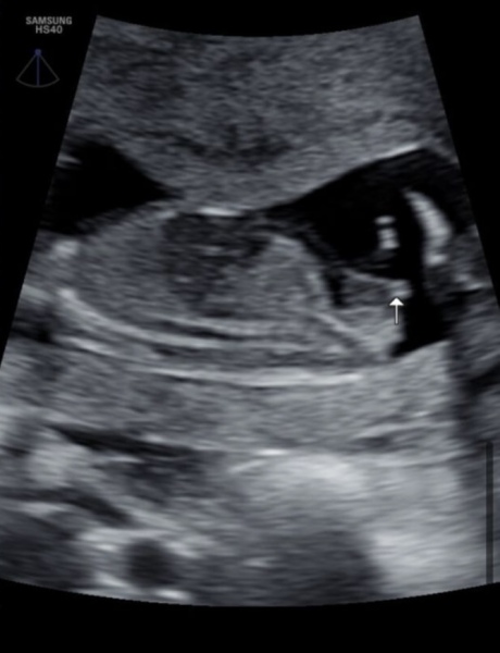 Any guesses on nub theory for fun during pregnancy?