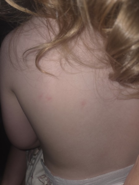 Does it look like chicken pox