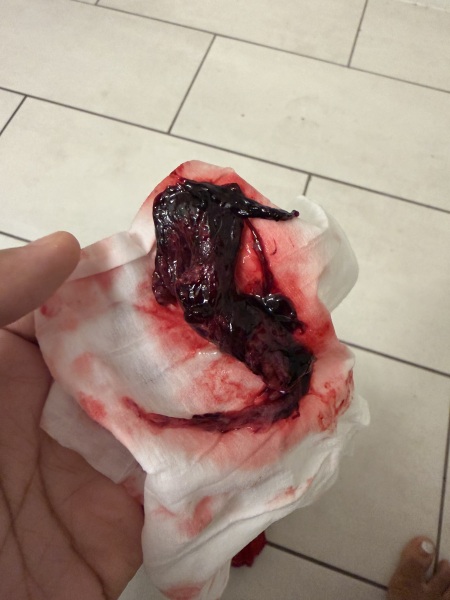 I think I may have had a miscarriage but am unsure [GRAPHIC PHOTOS ATTACHED]