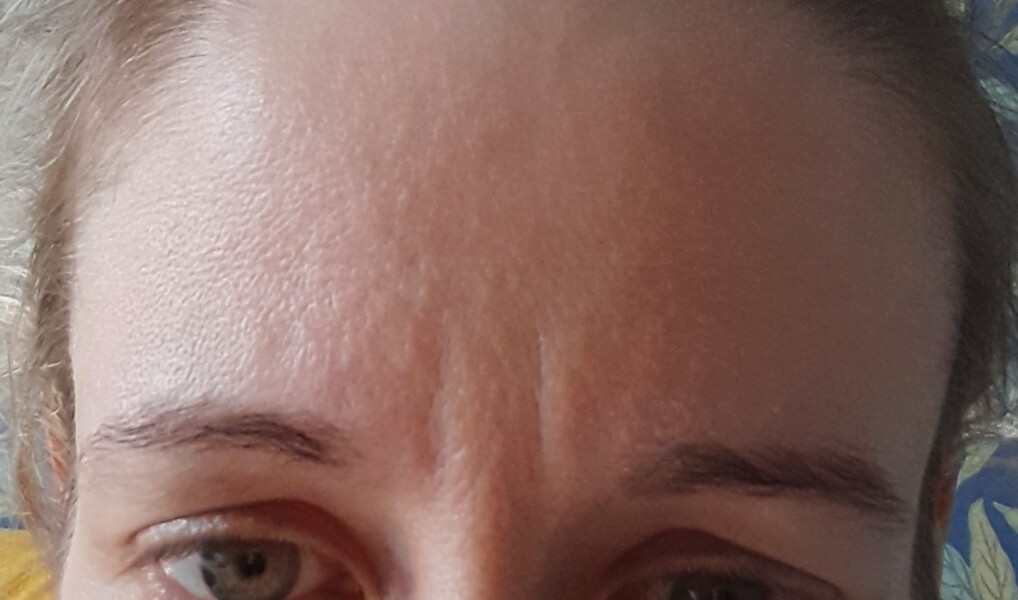 Can I ask some really basic questions about botox?