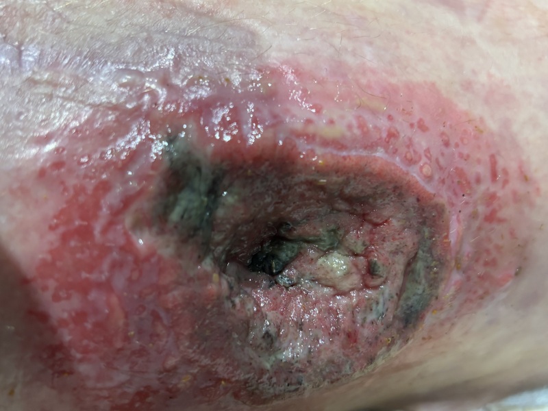 Chronic wound after dog attack, 6 months later