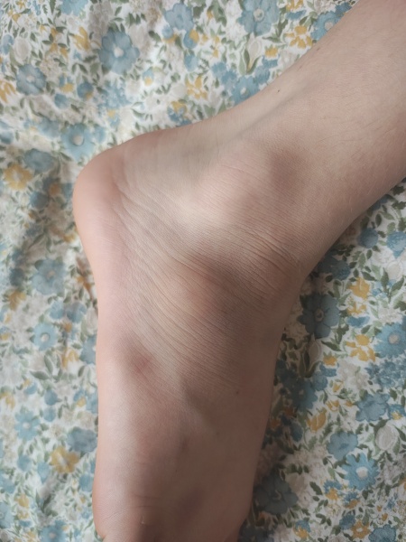 Possible foot fracture?