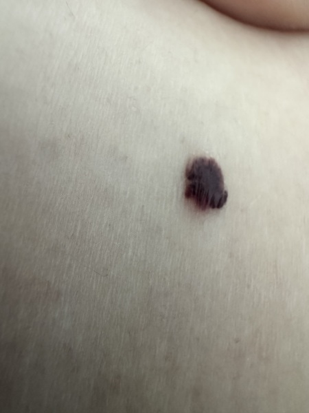 Darkened raised skin mark changing colour over the past year