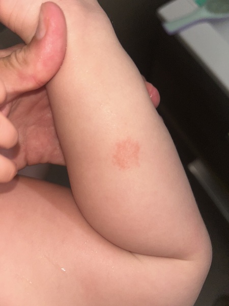 Is this ringworm on my baby?