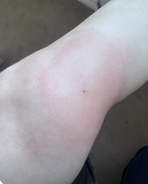 How concerned should I be about this big bite/sting?