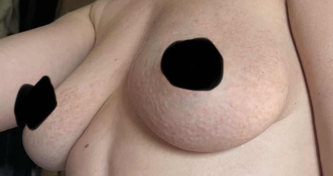 Itchy raised breast rash while breastfeeding and awaiting my period’s return