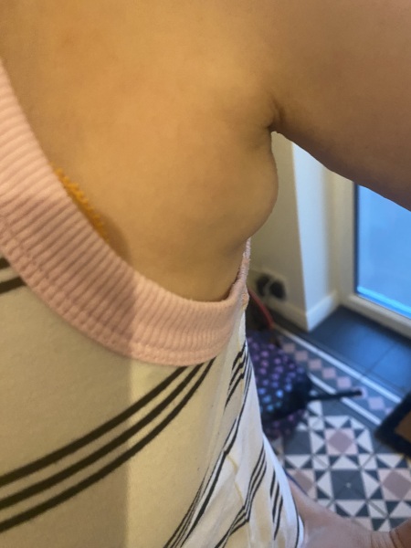 Lump under one armpit for a few weeks, should I worry?