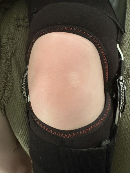 Knee dislocation & recovery