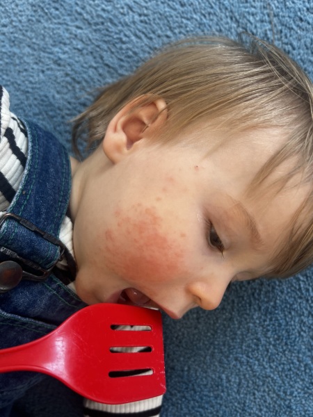 Eczema treatment advice for 13 month old?