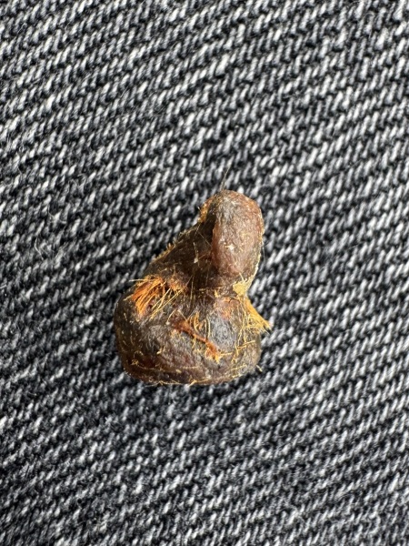 Ear wax lump from hell