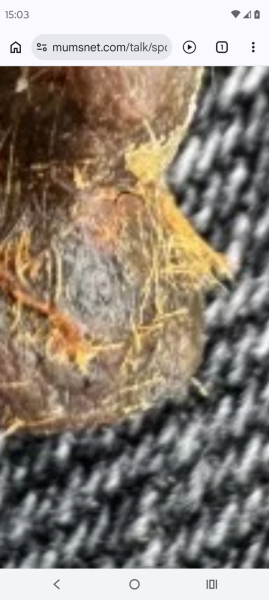 Ear wax lump from hell
