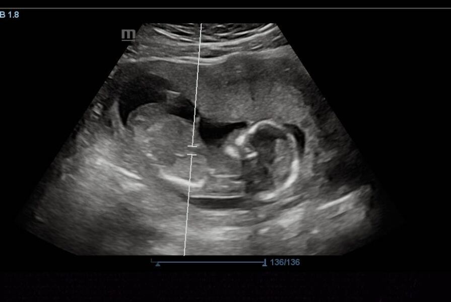 15 Week Scan - Baby Looks Squished, Fluid Level Low?