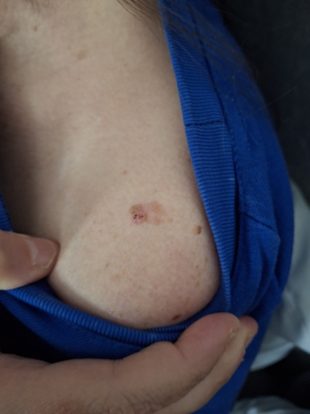 Worried about a line on my thumbnail before dermatologist appointment