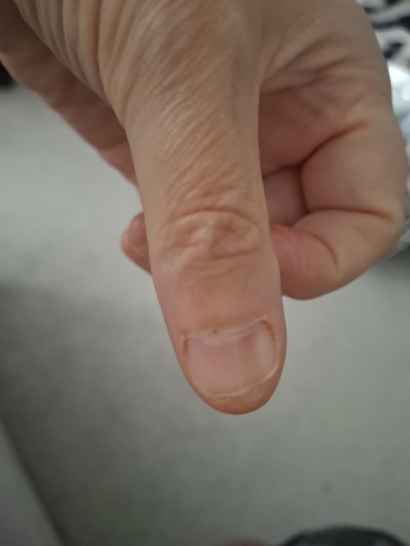 Any dermatologists here? Df thinks I may have skin cancer?