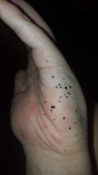 What are these black dots / marks on my daughter’s hands