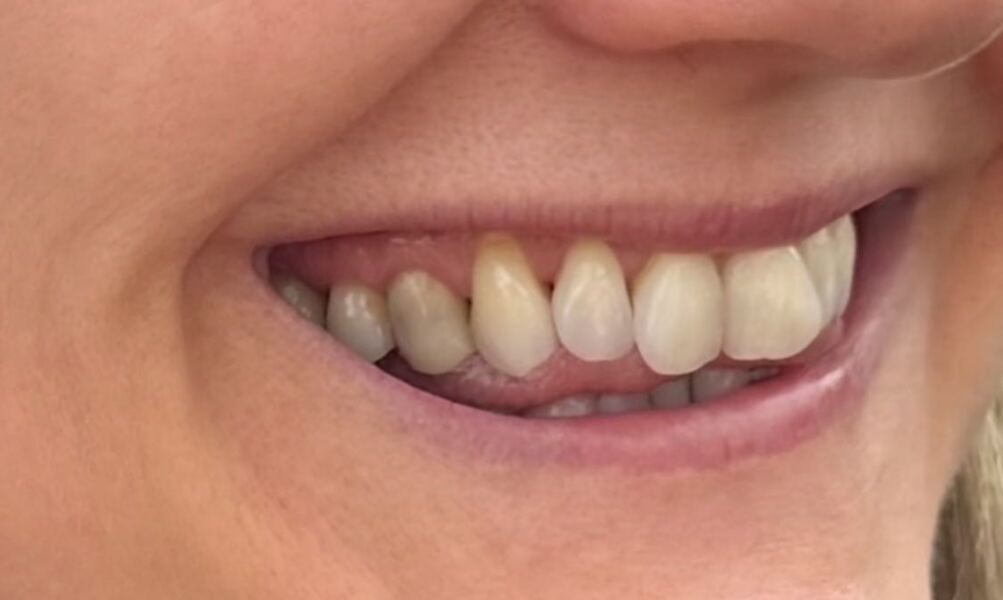 Critique my veneer please (dentists welcome)