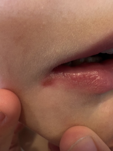 Cold sore or cracked lips?