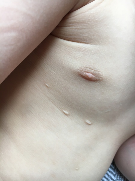 When will these chicken pox marks be gone?
