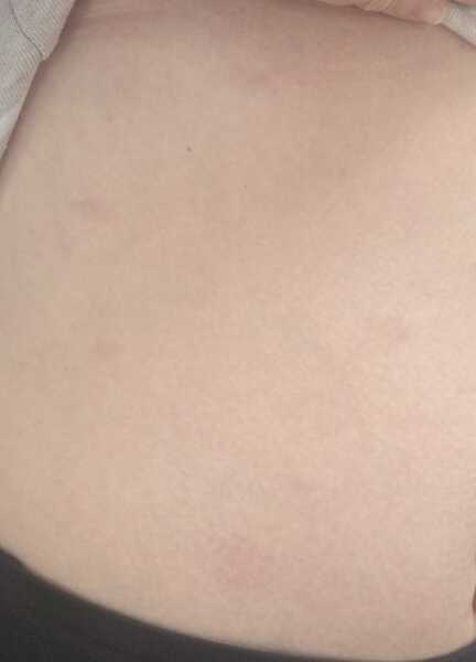 Discoloured patches of skin on abdomen. Anyone had this?