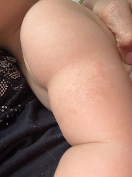 Bumps on upper arm