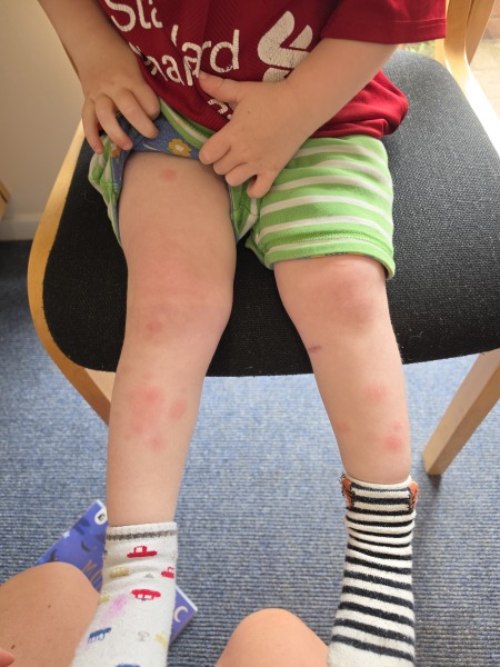 Could this spreading rash be a reaction after ciprofloxacin?