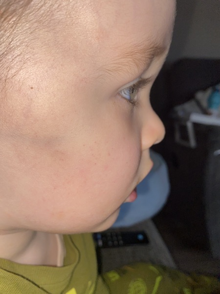 Has anyone's child developed facial petechiae after coughing with a cold?