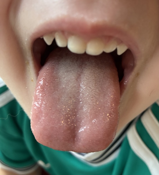DS white coating on tongue and bad breath