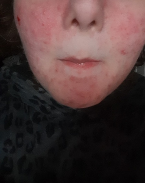 This is what normal skin of a 30+ woman looks like without makeup!