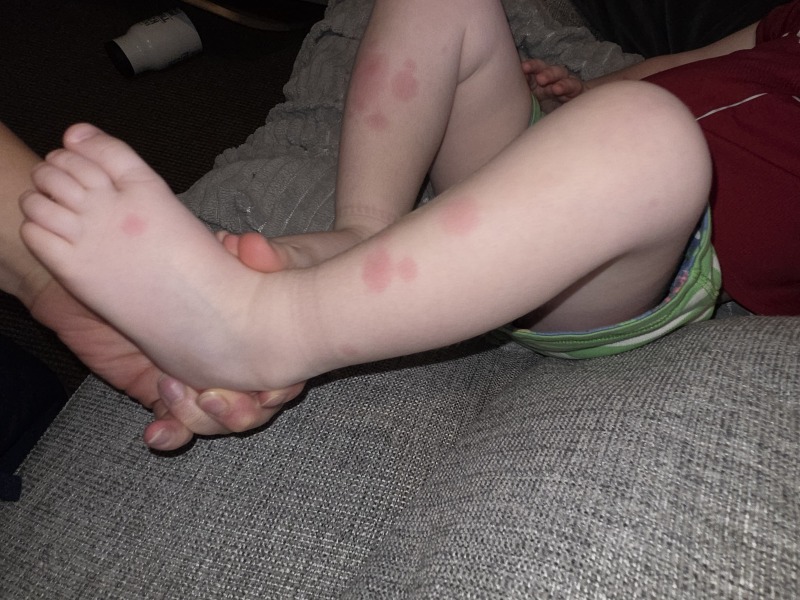 Could this spreading rash be a reaction after ciprofloxacin?