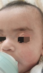 Advice on recurring rash and possible eczema or allergies in a baby