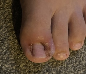 Partial toenail avulsion with phenol