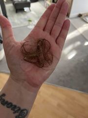 Hair loss after septic shock and ICU recovery, any advice?