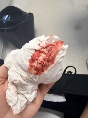 4w pregnant, painful bleed, tears getting stronger and stronger
